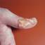 18. Symptoms of Herpes Pictures