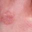 19. Symptoms of Herpes Pictures