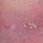 2. Symptoms of Herpes Pictures