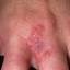20. Symptoms of Herpes Pictures