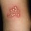 21. Symptoms of Herpes Pictures