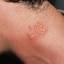 22. Symptoms of Herpes Pictures