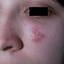 23. Symptoms of Herpes Pictures