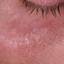 24. Symptoms of Herpes Pictures