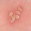 25. Symptoms of Herpes Pictures