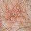 26. Symptoms of Herpes Pictures
