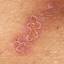 27. Symptoms of Herpes Pictures