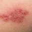 28. Symptoms of Herpes Pictures