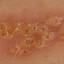 29. Symptoms of Herpes Pictures