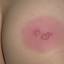 3. Symptoms of Herpes Pictures