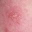 30. Symptoms of Herpes Pictures