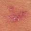 31. Symptoms of Herpes Pictures
