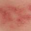 32. Symptoms of Herpes Pictures