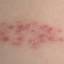 33. Symptoms of Herpes Pictures