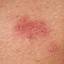 4. Symptoms of Herpes Pictures