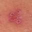 5. Symptoms of Herpes Pictures