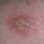 6. Symptoms of Herpes Pictures