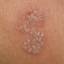 7. Symptoms of Herpes Pictures