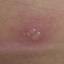 8. Symptoms of Herpes Pictures