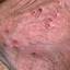2. Herpes Symptoms in Men Pictures