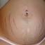 1. Stretch Marks During Pregnancy Pictures