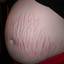 2. Stretch Marks During Pregnancy Pictures