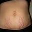 5. Stretch Marks During Pregnancy Pictures