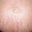 6. Stretch Marks During Pregnancy Pictures