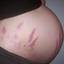 7. Stretch Marks During Pregnancy Pictures