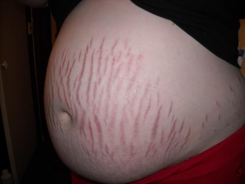 Stretch Marks During Pregnancy Pictures 7 Photos And Images