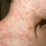 Three-Day Measles in Adults