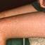 8. Three-Day Measles in Adults Pictures