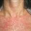 1. The Rash of Rubella in Adults Pictures
