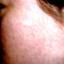 10. The Rash of Rubella in Adults Pictures