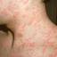 12. The Rash of Rubella in Adults Pictures