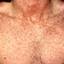 6. The Rash of Rubella in Adults Pictures