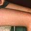 7. The Rash of Rubella in Adults Pictures