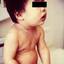 4. Rubella Baby Pictures