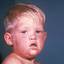 5. Rubella Baby Pictures