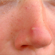 Nose Furuncle