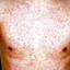 9. Symptoms of Rubella in Adults Pictures