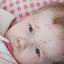 14. Chicken Pox in Infants Pictures