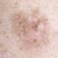 11. Early Melanoma Pictures