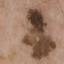 18. Early Melanoma Pictures
