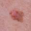 21. Early Melanoma Pictures