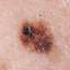 24. Early Melanoma Pictures