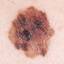 25. Early Melanoma Pictures
