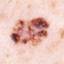 26. Early Melanoma Pictures