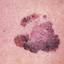 27. Early Melanoma Pictures