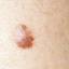 30. Early Melanoma Pictures